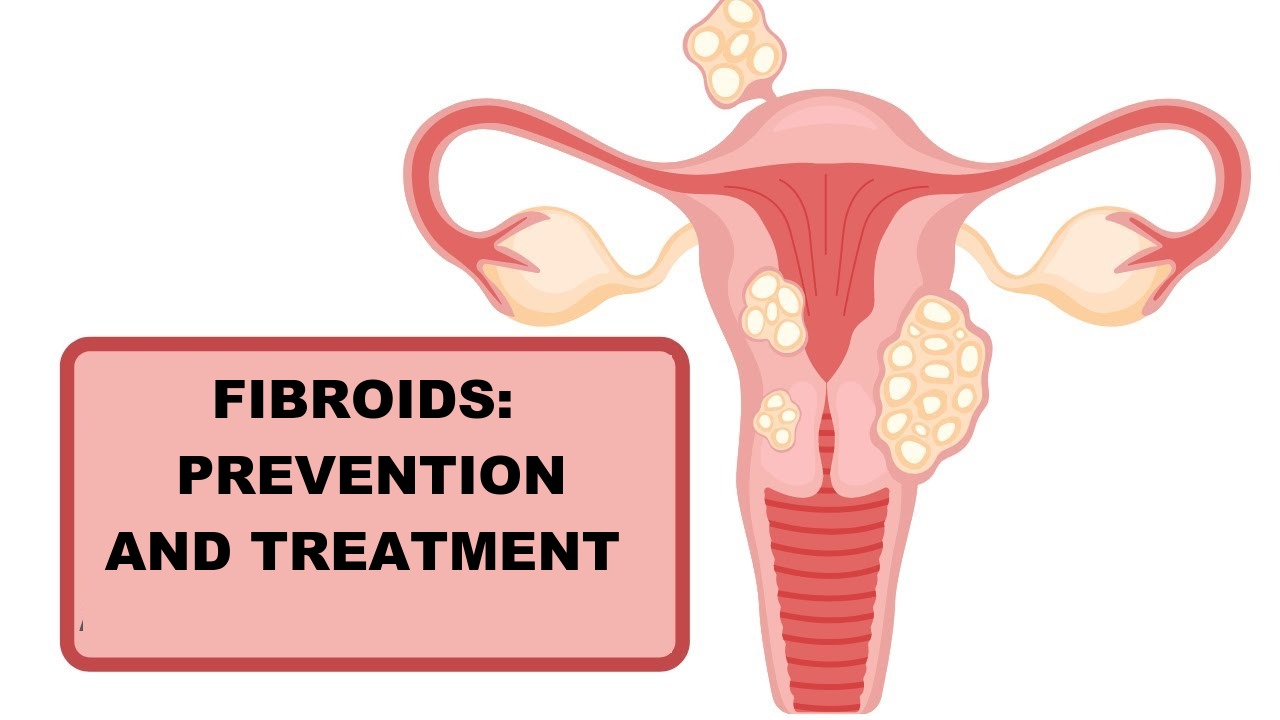 What are fibroids - What can you do