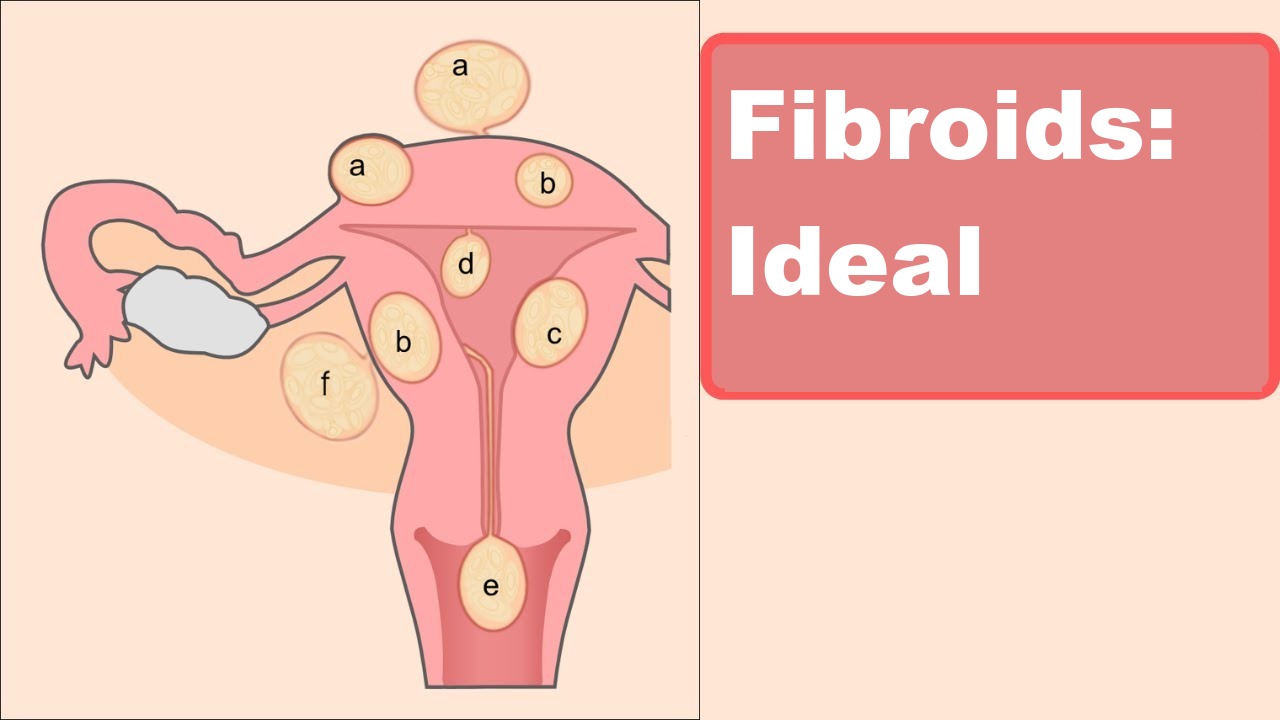 Fibroids: Ideal Diet