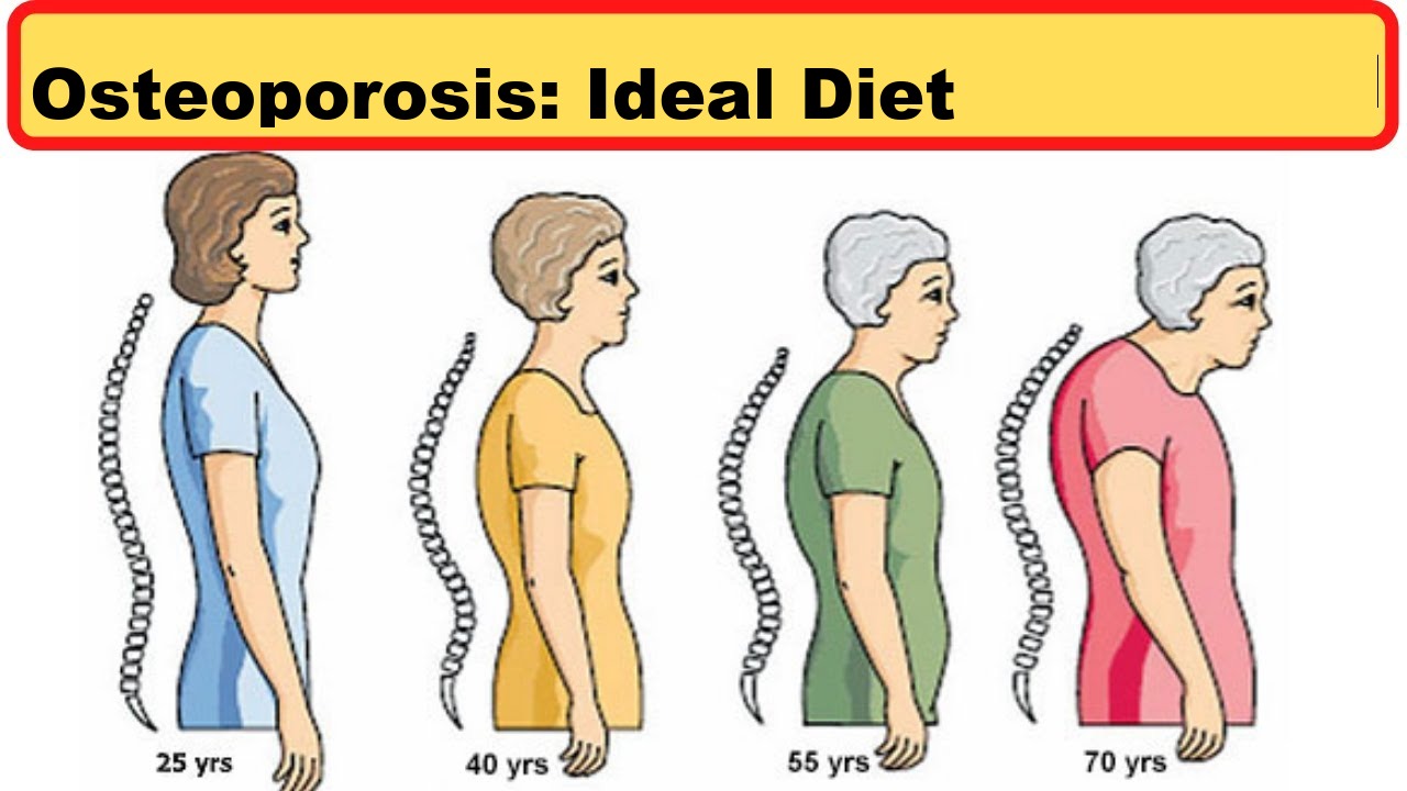 Osteoporosis: Ideal Diet