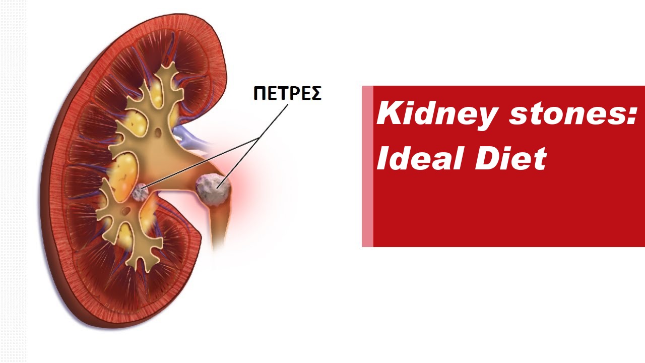 Kidney stones: Ideal Diet