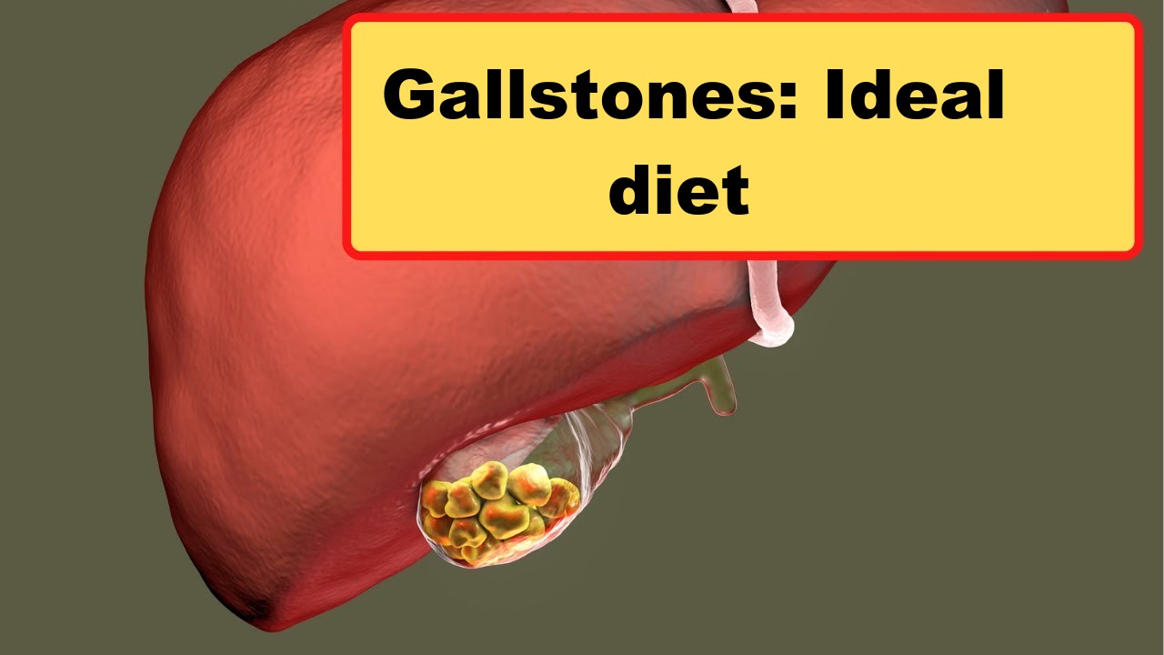 Gallstones: Ideal diet