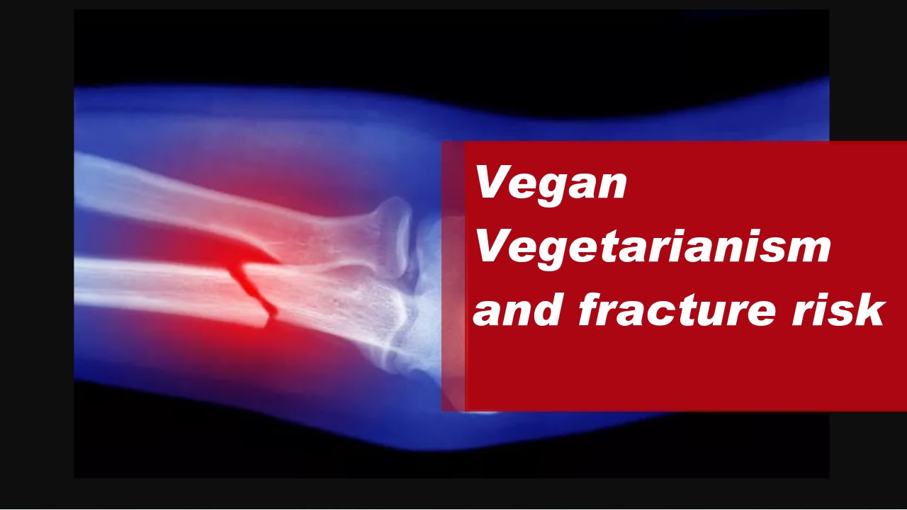 Vegetarian diet and fracture risk