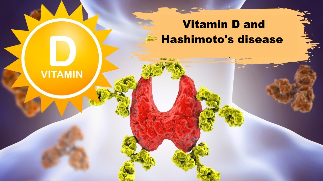 Vitamin D and Hashimoto's disease