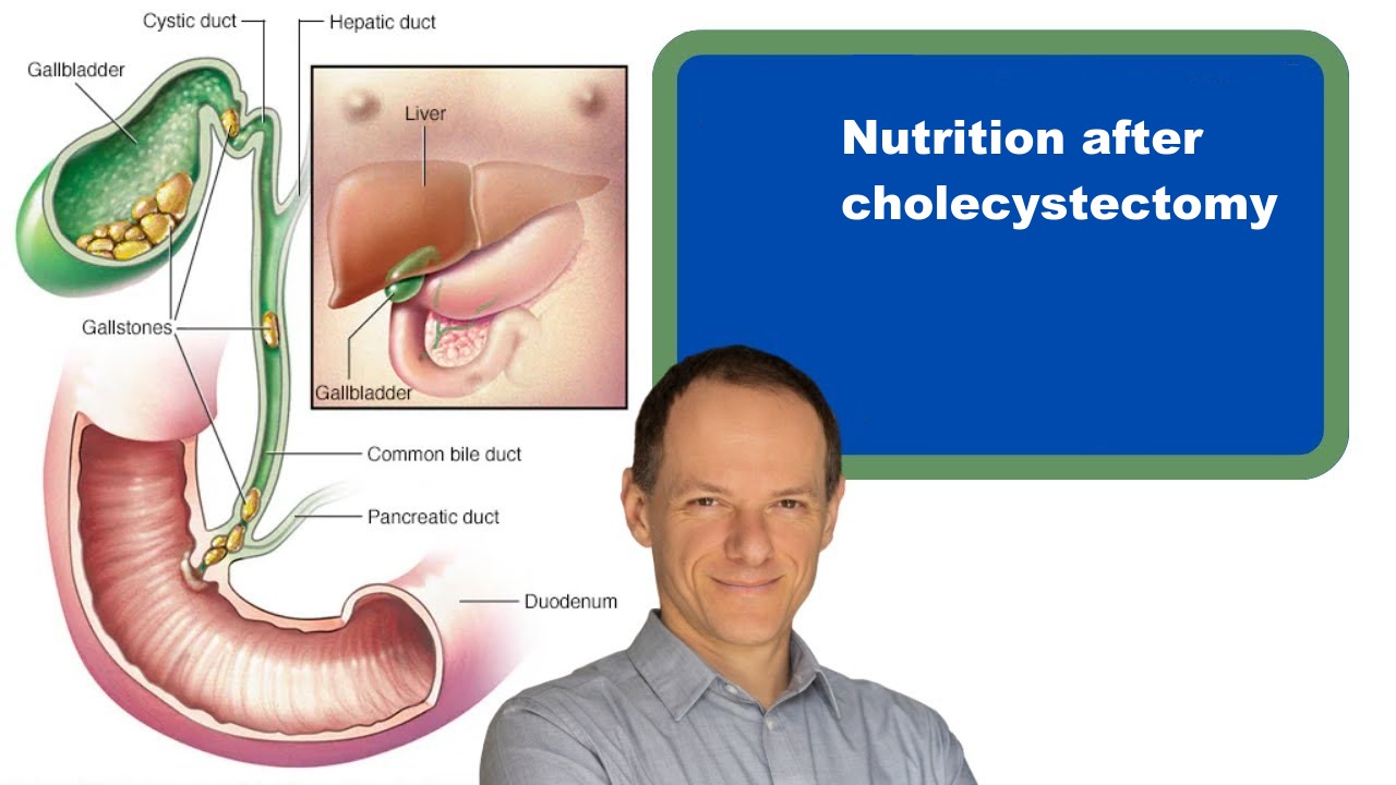 Nutrition after cholecystectomy